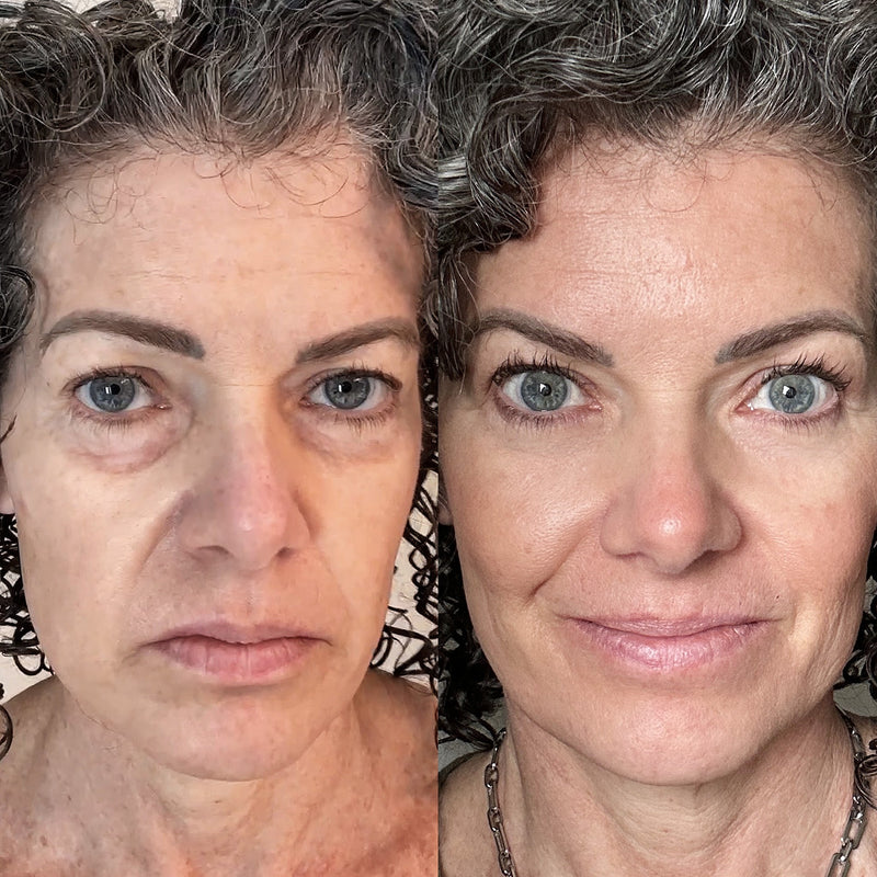 Reduced under-eye bags